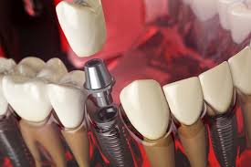 Have you checked all of the options mentioned above? Can I Get Dental Implants At A Dental School