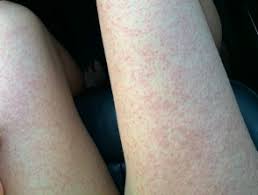 Symptoms include fatigue and brain fog. Covid 19 Images Dermnet Nz