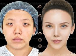 Our galleries showcase before and after plastic surgery pictures to supply you with as much insight into our previous client's results. Before And After Face Procedures Wave Plastic Surgery
