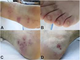 Figure 1 from Sacral (S1) herpes zoster