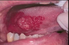Treatment of a sore throat depends if it is viral, bacterial, or symptoms that indicate you have a sore throat caused by bacteria like strep include severe throat arcanobacterium causes sore throats mainly in young adults and is sometimes associated with a. Mouth And Throat Cancer Ear Nose And Throat Disorders Merck Manuals Consumer Version