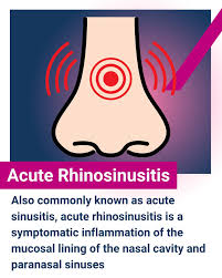 Image result for Rhinosinusitis