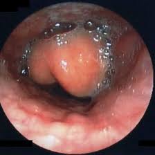 Image result for Epiglottitis