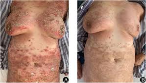 Image result for Generalized Rash