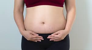 Ada tak option cara hilangkan stretch mark macam kat perut saya ni? 7 Tips Menghilangkan Stretch Mark Setelah Kehamilan