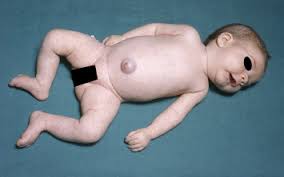 Evaluation of the floppy infant - ScienceDirect