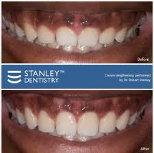 Crownlenghtening Gums Gummy Dentistry Dentist Teeth Smile Transformation Cary Nc Northcarolina Souther Dentistry Cosmetic Dentistry Dental Services