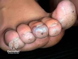 Image result for Glomus tumor