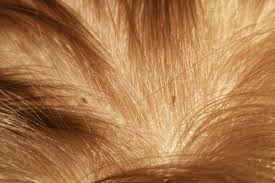 Lice At Base Of Scalp Louse Lice Remedies Hair