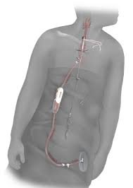 The internal carotid arteries do not supply any structures in the neck, entering the cranial cavity via the the neck is supplied by arteries other than the carotids. Uh Contributes To Valuable Research For Patients With Carotid Artery Disease University Hospitals