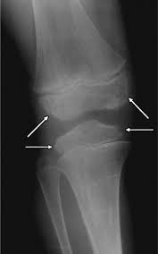 Imaging Findings Of Metabolic Bone Disease Radiographics
