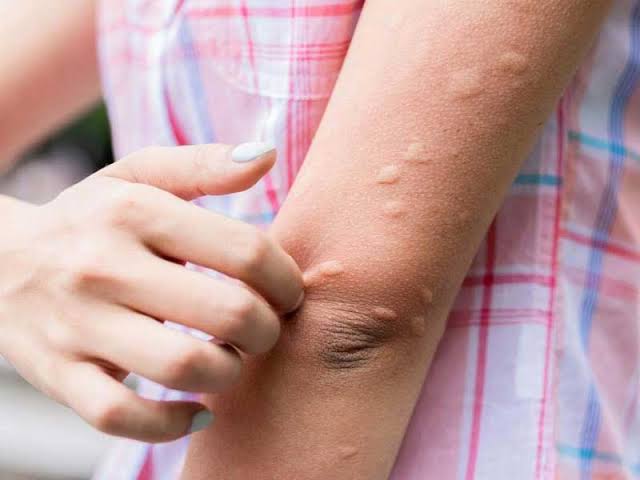 Japanese encephalitis | Duff Street Medical Clinic