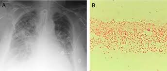 A number of strains have been identified. Pdf Carbapenemase Producing Raoultella Planticola A Rare Cause Of Pneumonia And Bacteremia Semantic Scholar