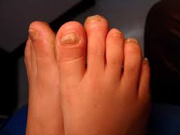 Image result for Clubbing nails feet