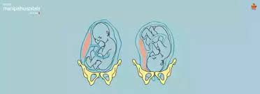 Image result for External Cephalic Version