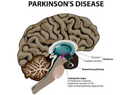 It is a chronic and progressive disease, meaning that the symptoms become worse over time. About Parkinson S Shake It Up Australia Foundation