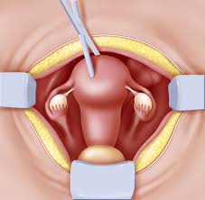 Pin On Hysterectomy Recovery