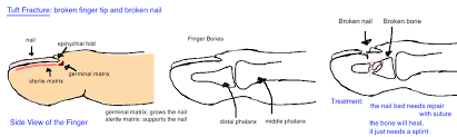 Sep 30, 2017 · the finger is placed in a splint to keep the bone properly aligned. Nailbed Injury Broken Finger Tip Bone Talks