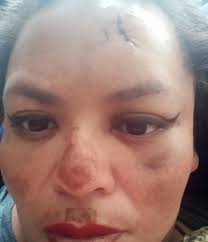 Surviving domestic abuse with a concussion