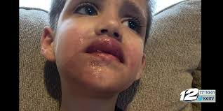 Texoma boy burned by chemicals