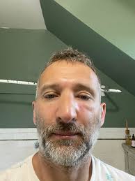 What happened after getting stung by a bee?