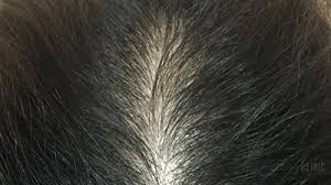 Hair loss caused by a medical condition usually finasteride and minoxidil are the main treatments for male pattern baldness. Hair Loss Treatment Peter Ch Ng Skin Specialist Kl Malaysia
