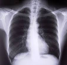 Contributed by ihab hosny, m.d. Distinction Of Malignant Mesothelioma From Benign Mesothelioma In Effusions Research Saypeople