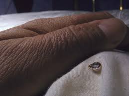 12 Questions About Bed Bugs