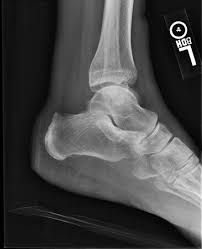 Image result for Foot Drop