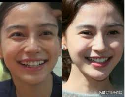 Do plastic surgeons elect to undergo cosmetic surgery more than the average american? The No 1 Plastic Surgery Template In Asia In The Past Few Years Angelababy S Face Value Change Inews