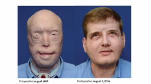 One Year After Historic Face Transplant, Former Firefighter Thrives