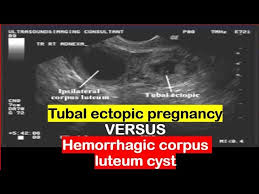 Image result for corpus luteum sonography)