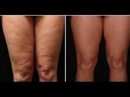 Como Eliminar La Celulitis De Las Piernas Y Gluteos Rapidamente En Casa Pin En Adelgazar