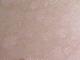 Home » penyakit dan kelainan » panu » 13 cara menghilangkan panu di muka dengan bahan panu yang menjadi salah satu jenis penyakit kulit ini disebabkan karena jamur. Panau Wikipedia Bahasa Indonesia Ensiklopedia Bebas