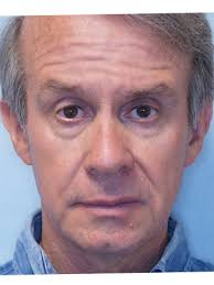 Droopy Eyelid Surgery* 1829