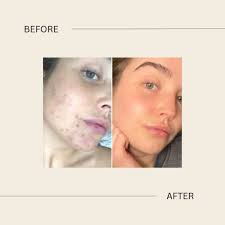 ✨ “I don't know why my skin is breaking out…” But the truth is your skin  always tells a story so stop the guess work! At Leanne Rea Medical  Aesthetics, we help