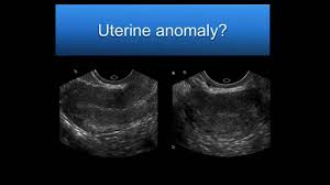 Aium Webinar Problem Solving With 3d Sonography Of The Uterus And Adnexa Youtube