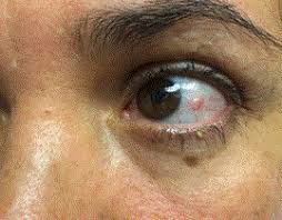 Image result for conjunctival melanoma