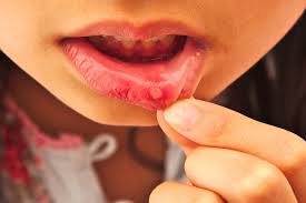 Image result for Pharyngitis