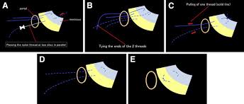 It's most useful for high tension wounds especially when the edges are fragile or frayed. Application Of A Horizontal Mattress Suture A Passing The Nylon Download Scientific Diagram