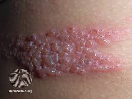 Image result for skin rash acute hiv infection