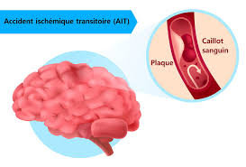 Certains accidents vasculaires cérébraux régressent en quelques minutes sans laisser de séquelles quand d'autres. Accident Ischemique Transitoire Ait Symptome Consequence
