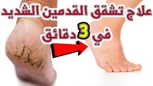 علاج تشقق القدمين الشديد في 3 دقائق تشققات الكعبين علاج تشقق القدمين thumbs up