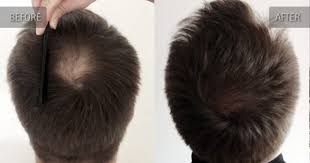 Repairhairloss With Finasteride Hair Transplant Male Pattern Hair Loss Hair Restoration