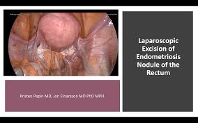 Common signs and symptoms of endometriosis include: Laparoscopic Excision Of Endometriosis Nodule Of The Rectum