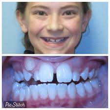 Benjamin Newcomb brought us a pumpkin he carved to have matching braces  just like him! You did awesome! 🤩 👏 🎃