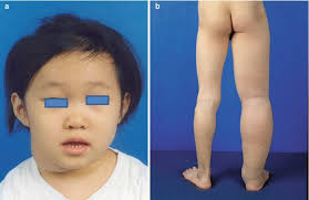 Lymphatic Vascular Malformations of the Limbs: Treatment of Extratruncular  Malformations