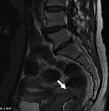 Image result for Incidental Imaging Finding
