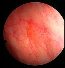 Getting tested for bladder cancer can give you peace of mind and ensure you receive any treatment you may need. Urinary Bladder Cancer