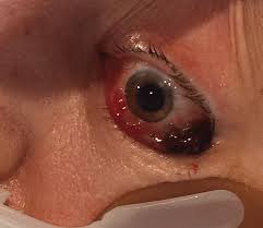 Image result for Proptosis